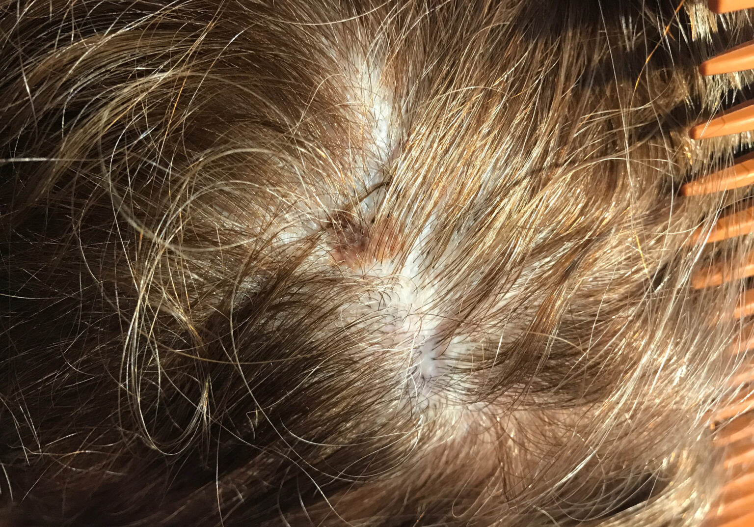 Scalp melanoma pictures | Symptoms and pictures