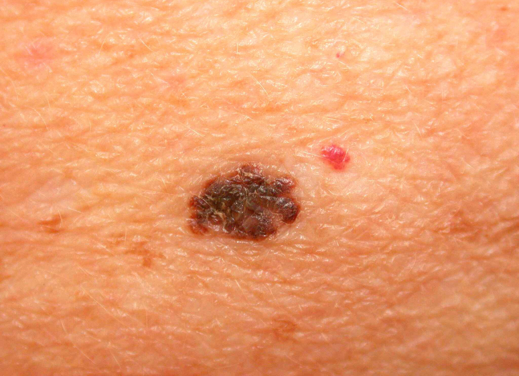 Stage 1 early stage melanoma images | Symptoms and pictures