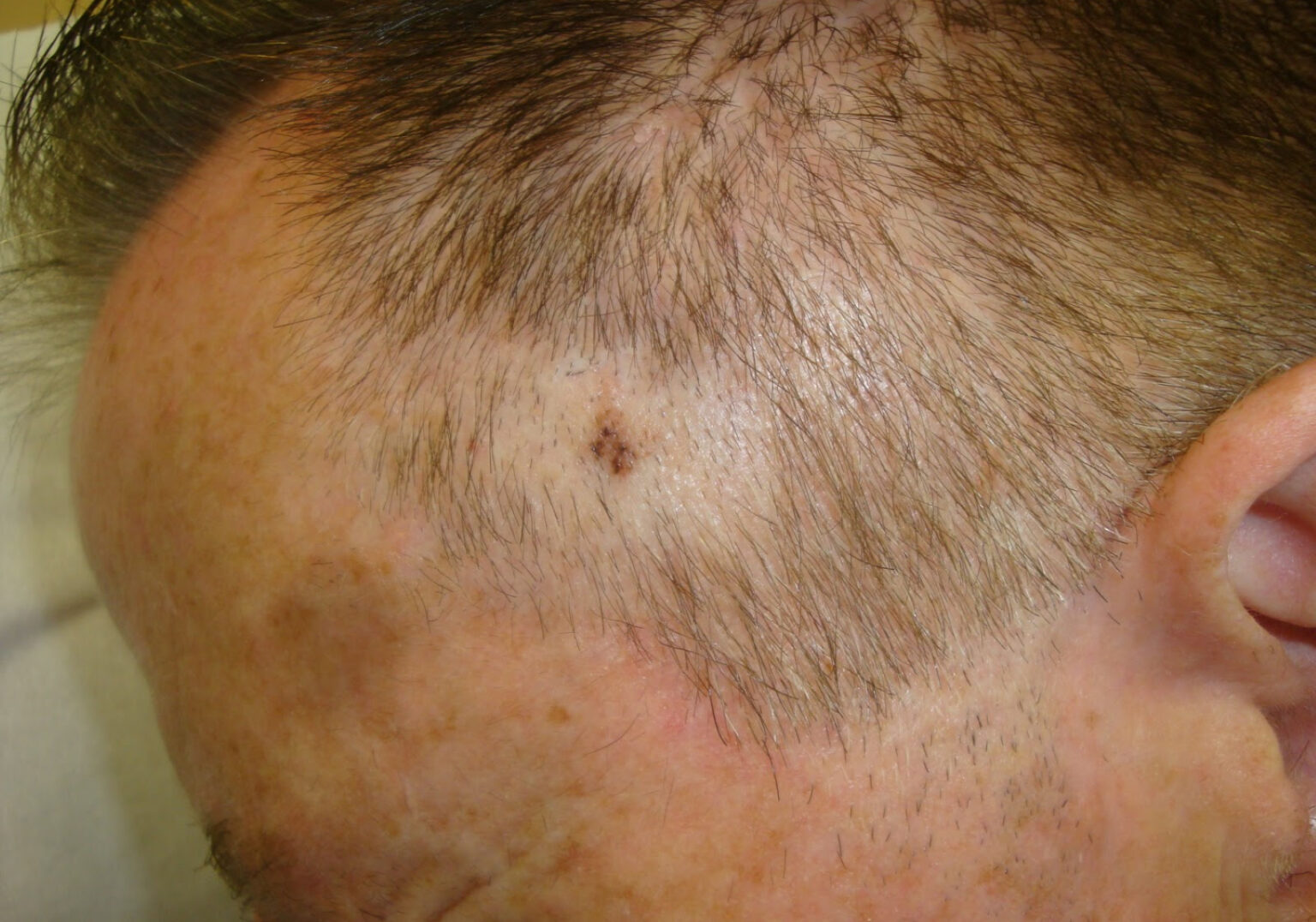 What Does Melanoma On The Scalp Look Like