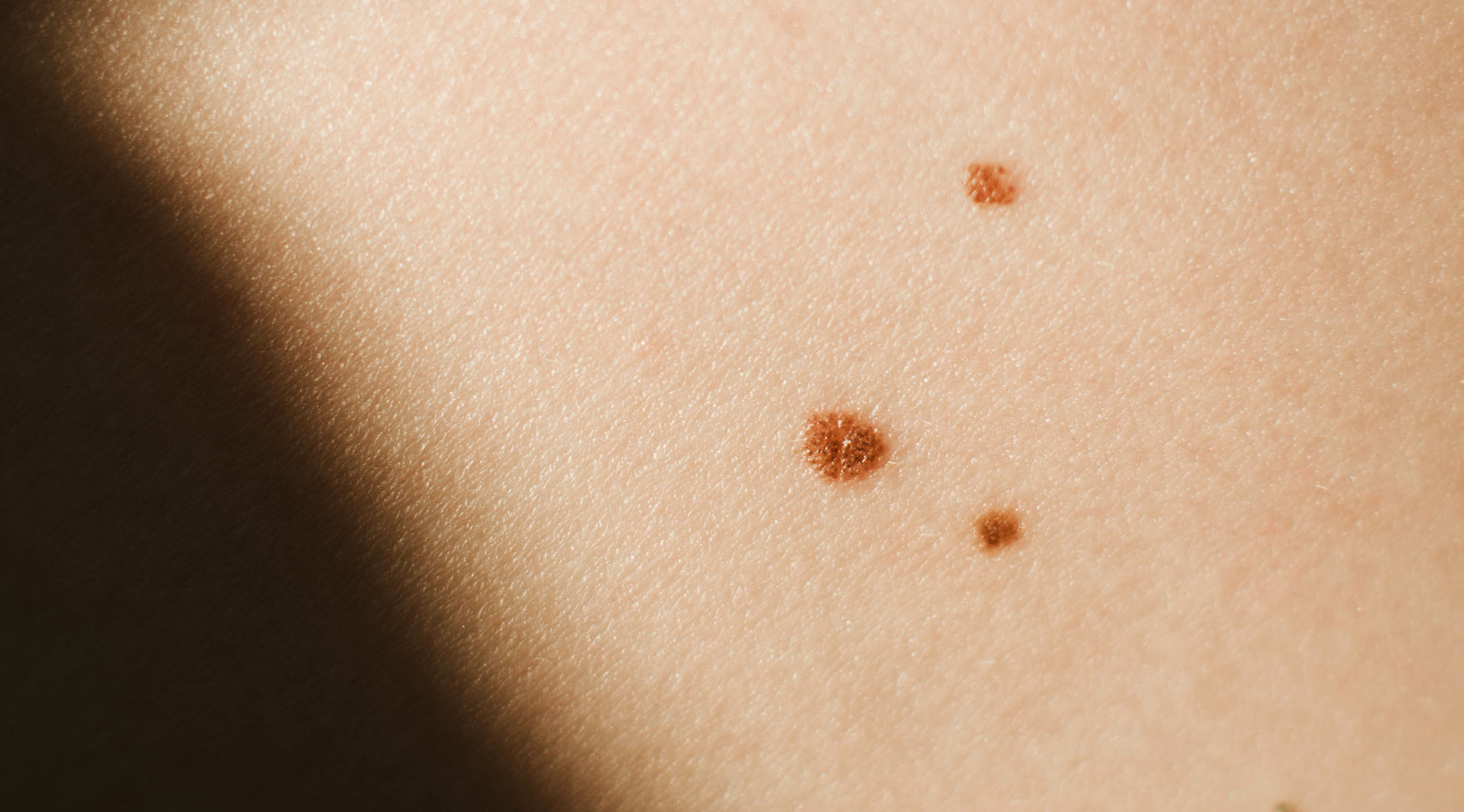 Stage 1 melanoma pictures