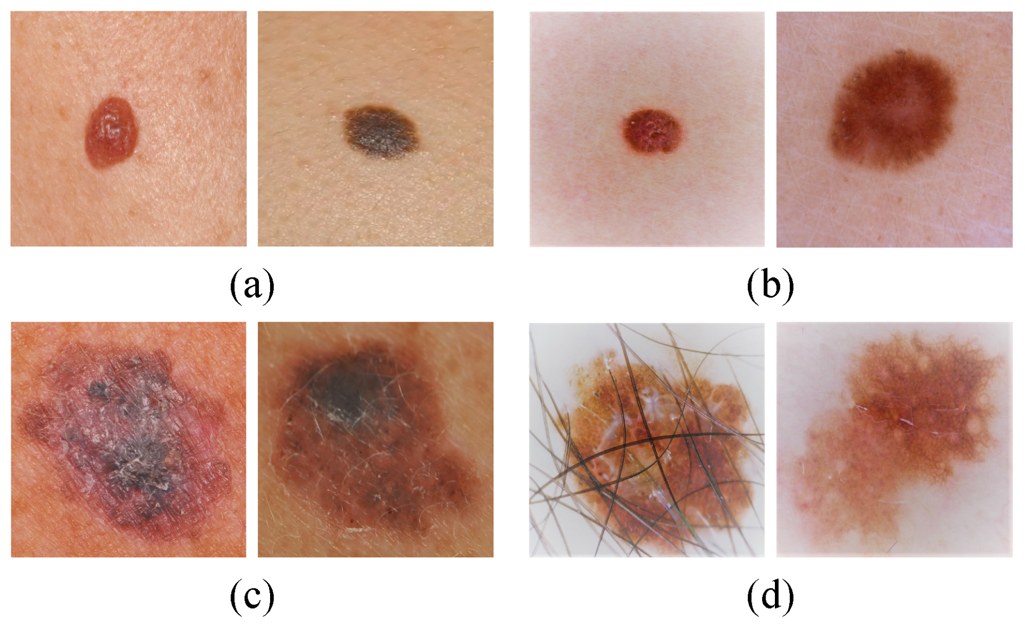 Stage 2 melanoma pictures