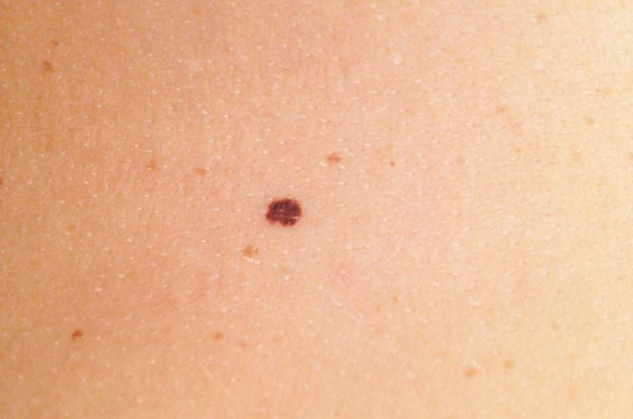 Stage one melanoma pictures