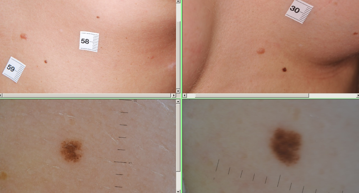 Stages of melanoma pictures