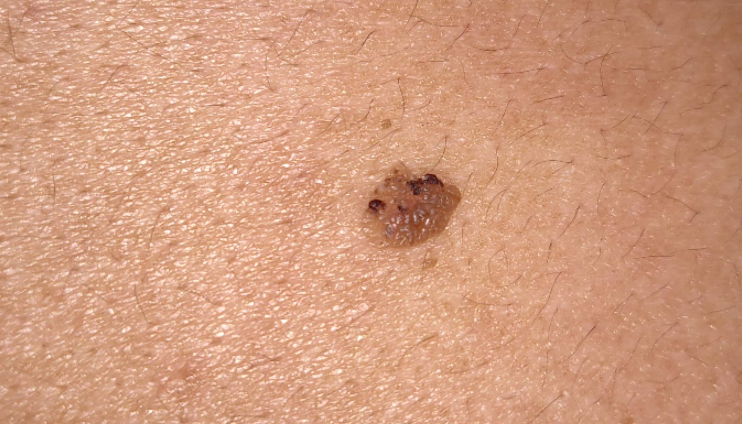 Start of melanoma pictures