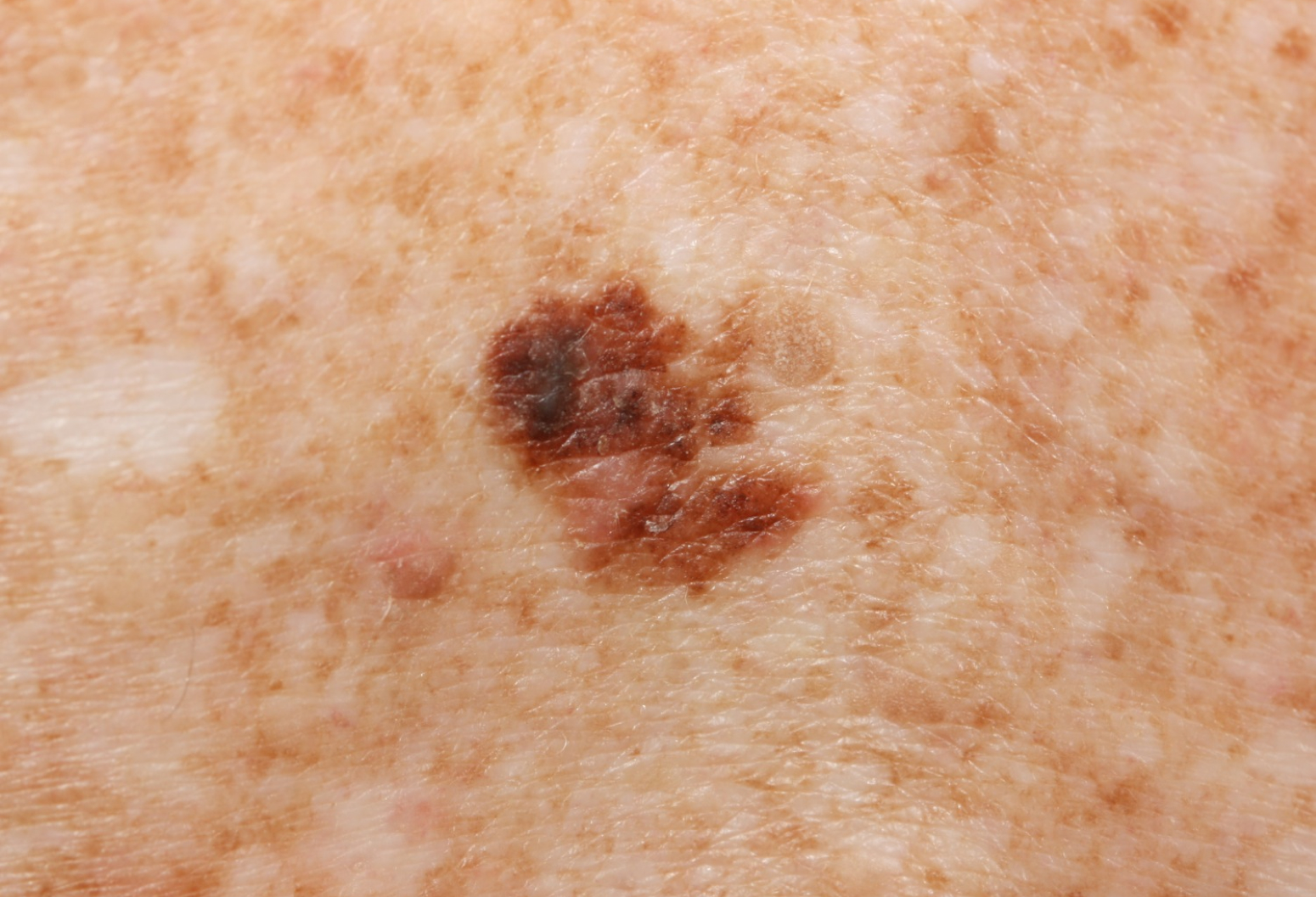 What does a small melanoma look like