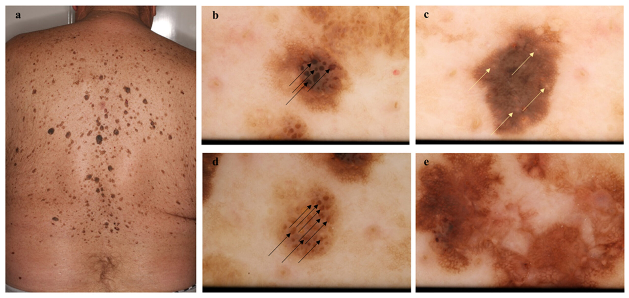 What does advanced melanoma look like