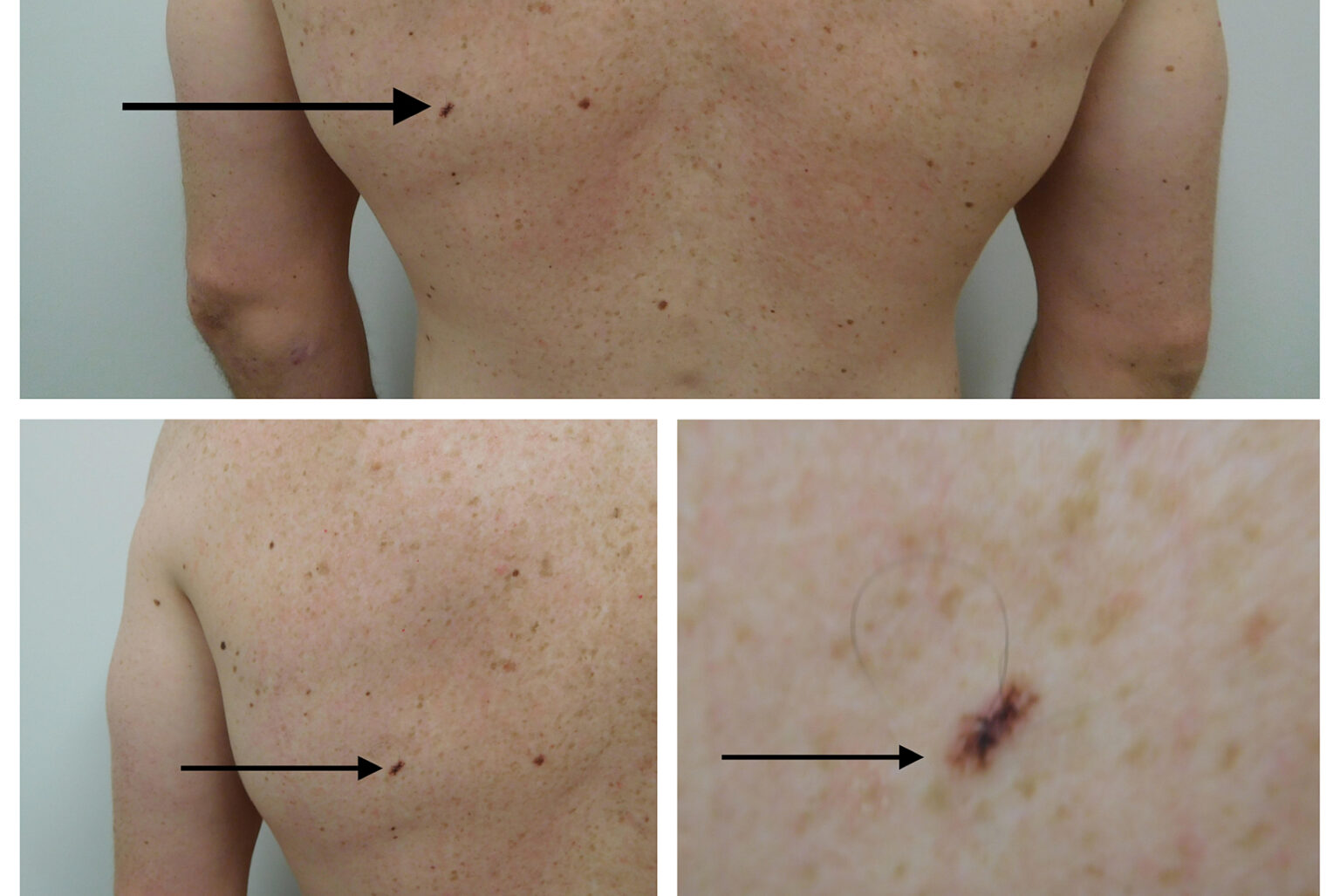 What does melanoma in situ look like Symptoms and pictures