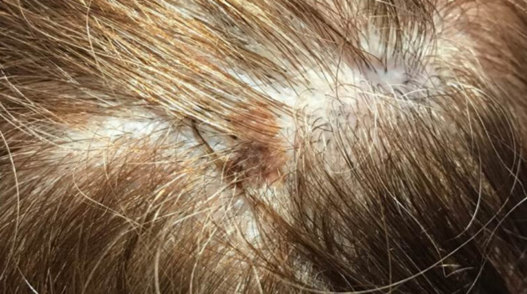 Skin Cancer Bump On Scalp