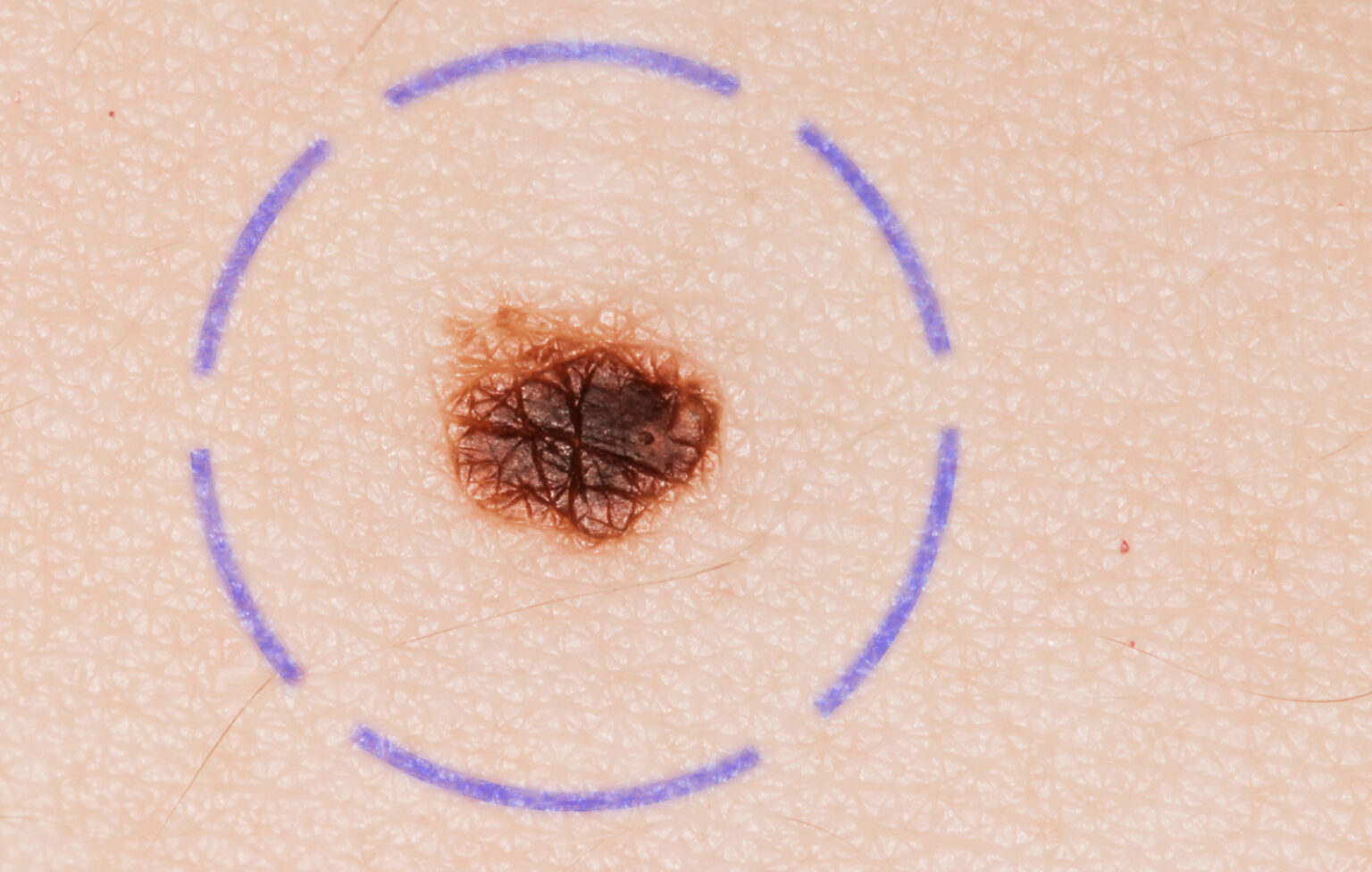 What does stage 2 melanoma look like | Symptoms and pictures