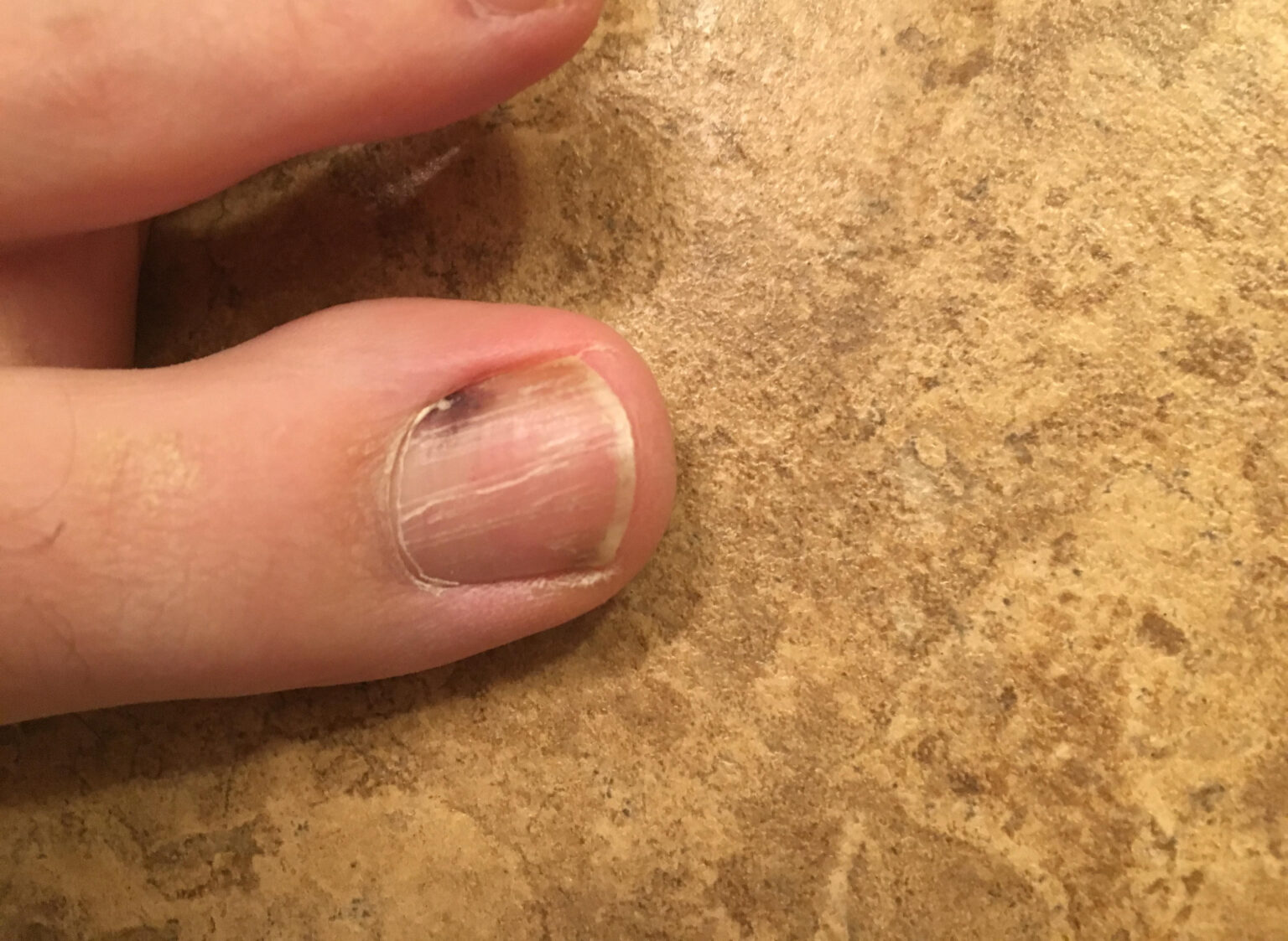 Melanoma Under Toenail Pictures Black Spot Nail Melanoma Pictures 