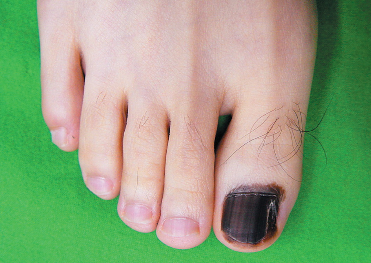 Cancer Under Toenail Pictures 