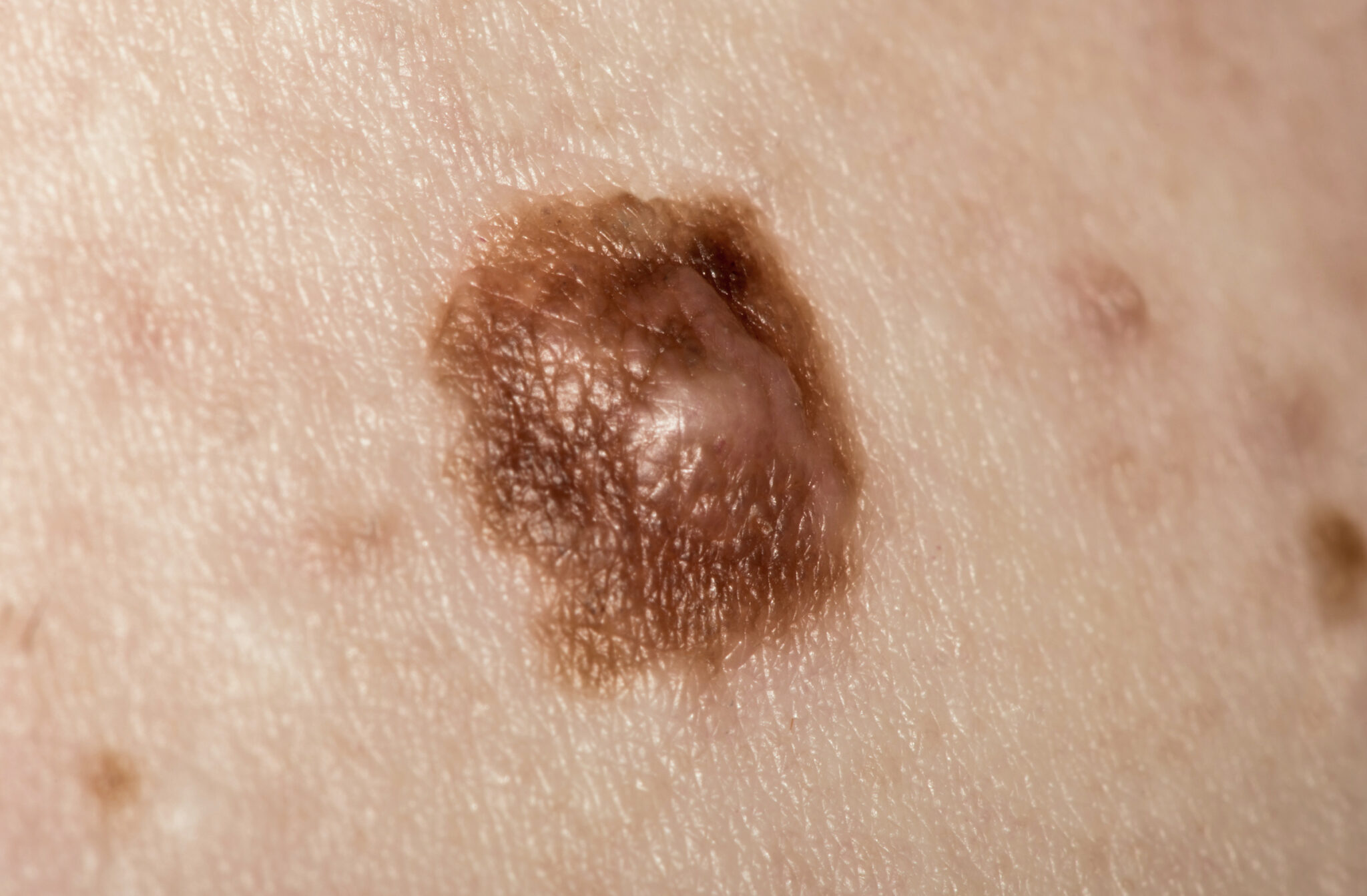 cancerous moles images 