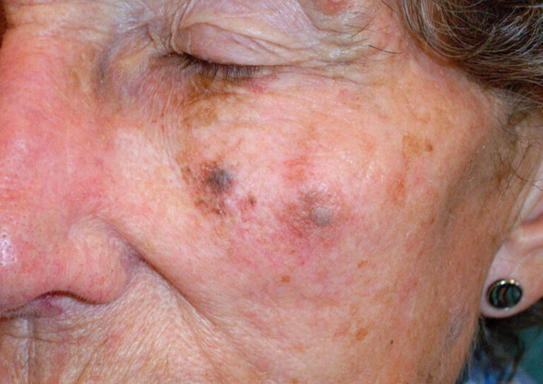 Cancerous Moles On Face Pictures Symptoms And Pictures   Cancerous Moles On Face Pictures 768x544 