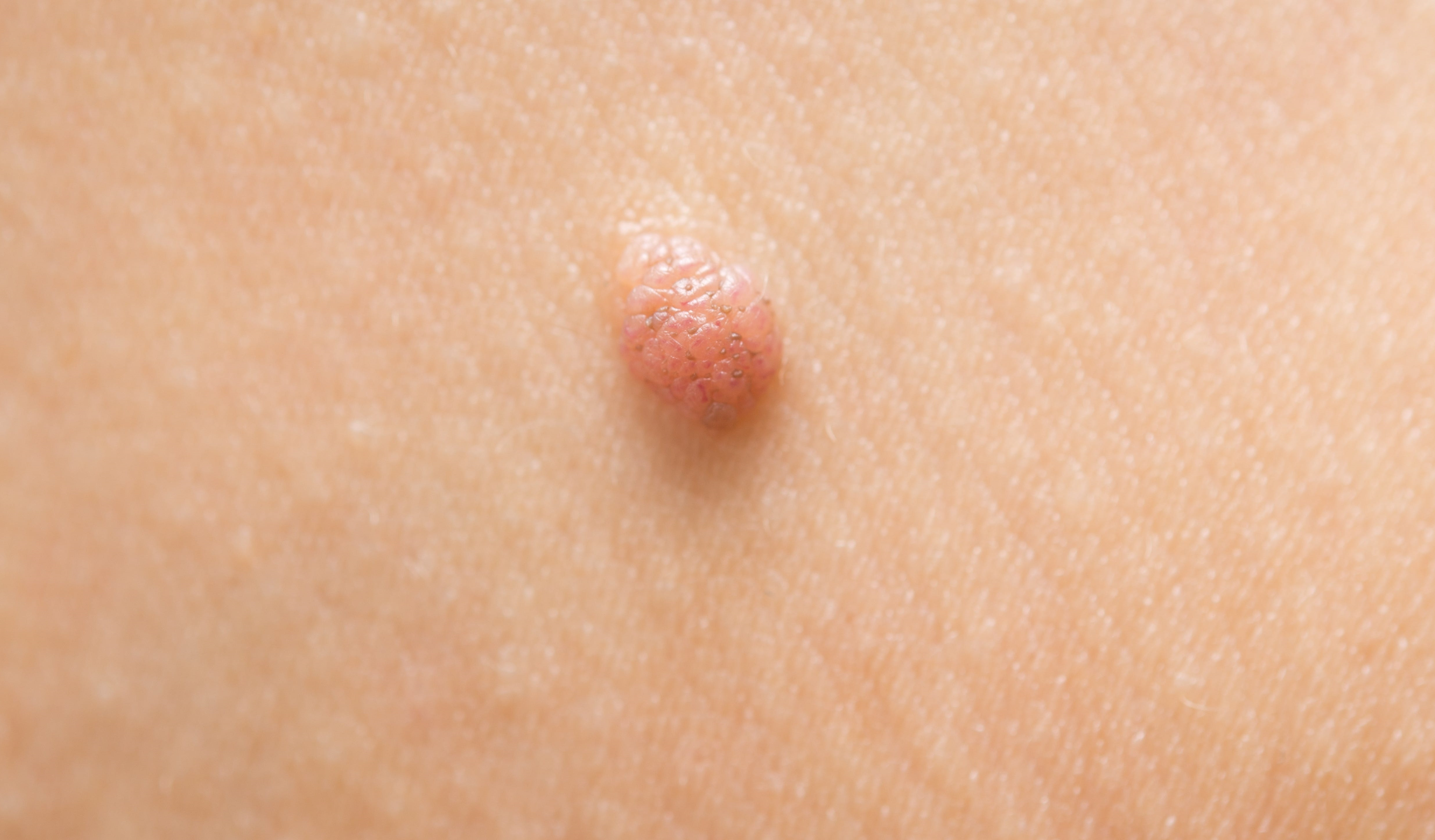 cancerous moles pics