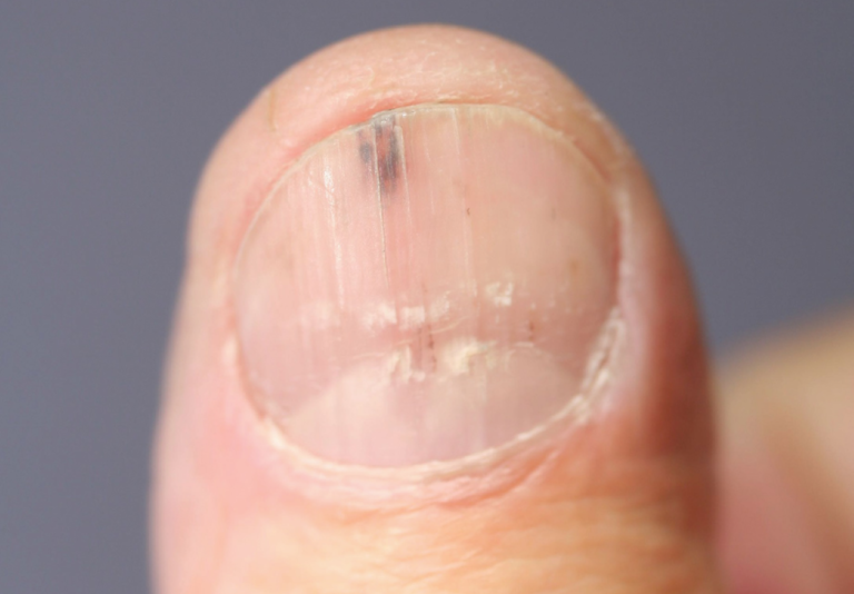 Early Stage Nail Cancer Pictures Symptoms And Pictures