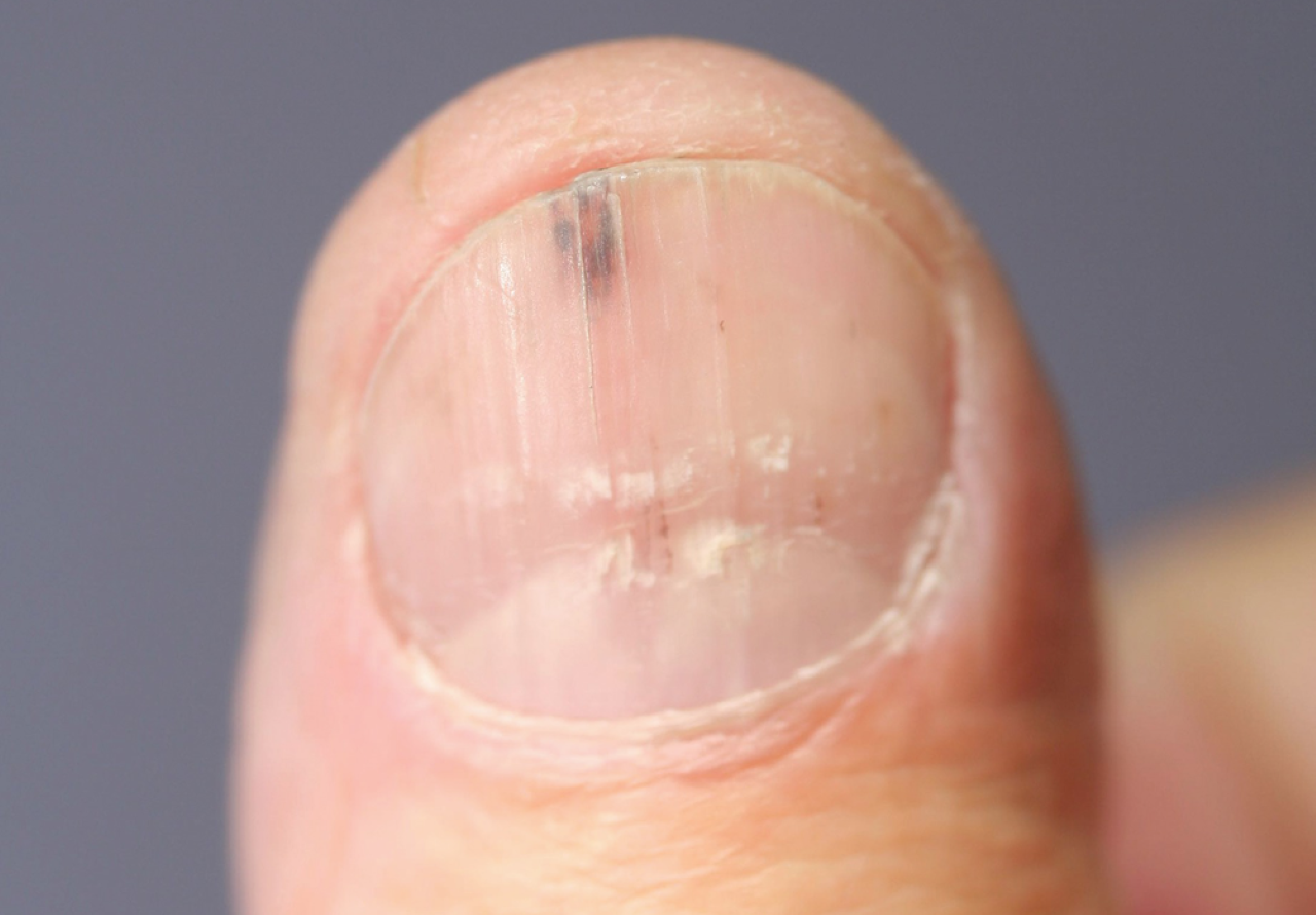 early-stage-nail-cancer-pictures-symptoms-and-pictures