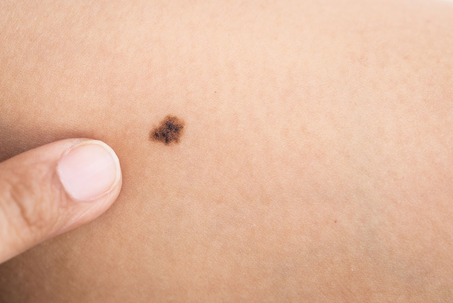 Pictures of cancerous moles: early stage, cancerous moles images