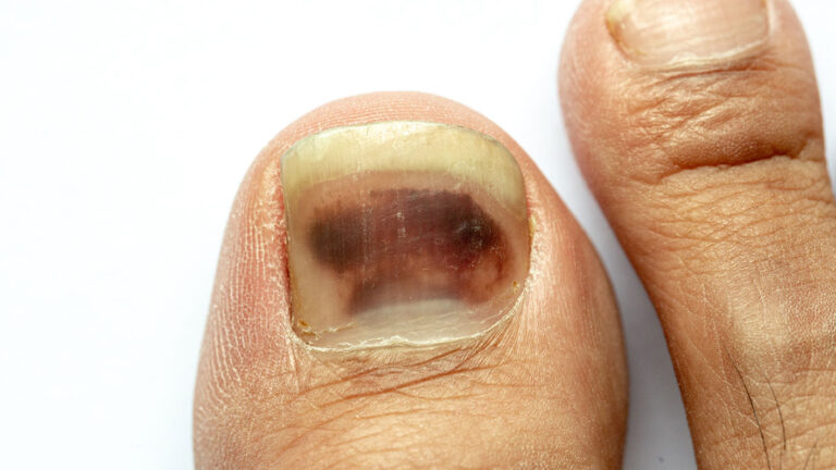 Fingernail Melanoma Images Symptoms And Pictures