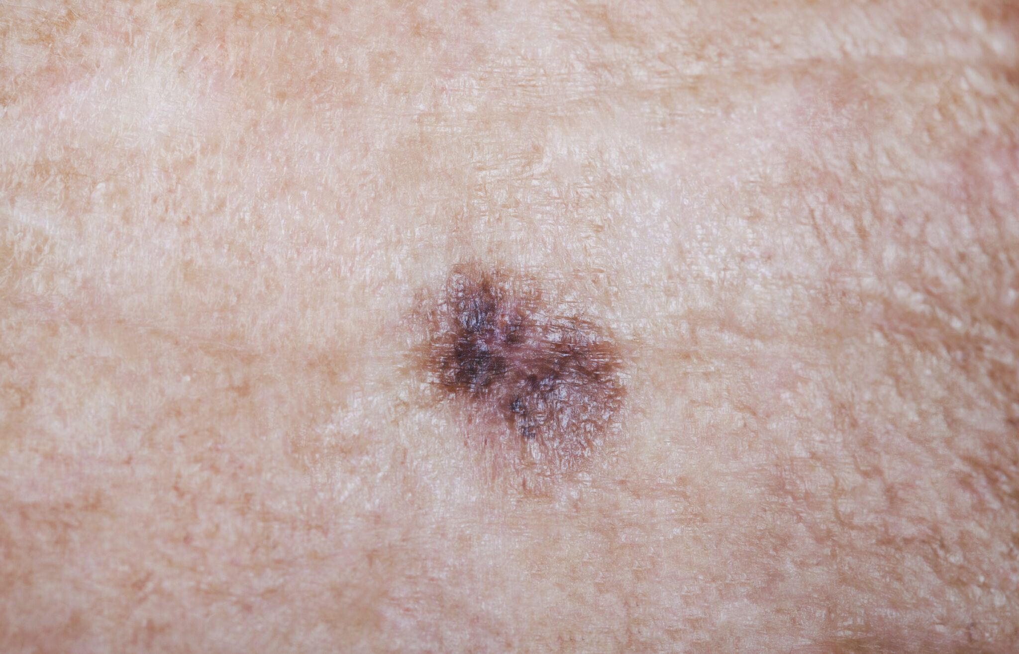 how-cancerous-moles-look-like-symptoms-and-pictures