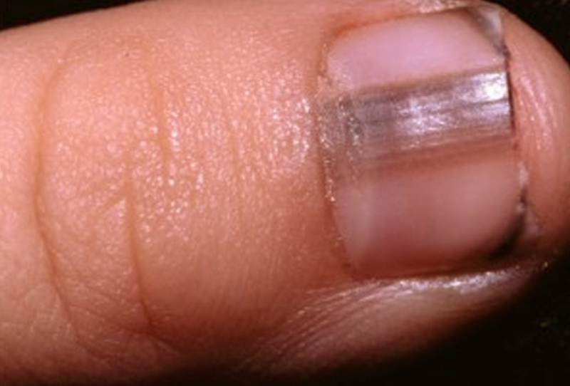 image of melanoma under toenail