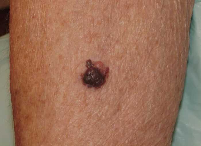 malignant moles pictures