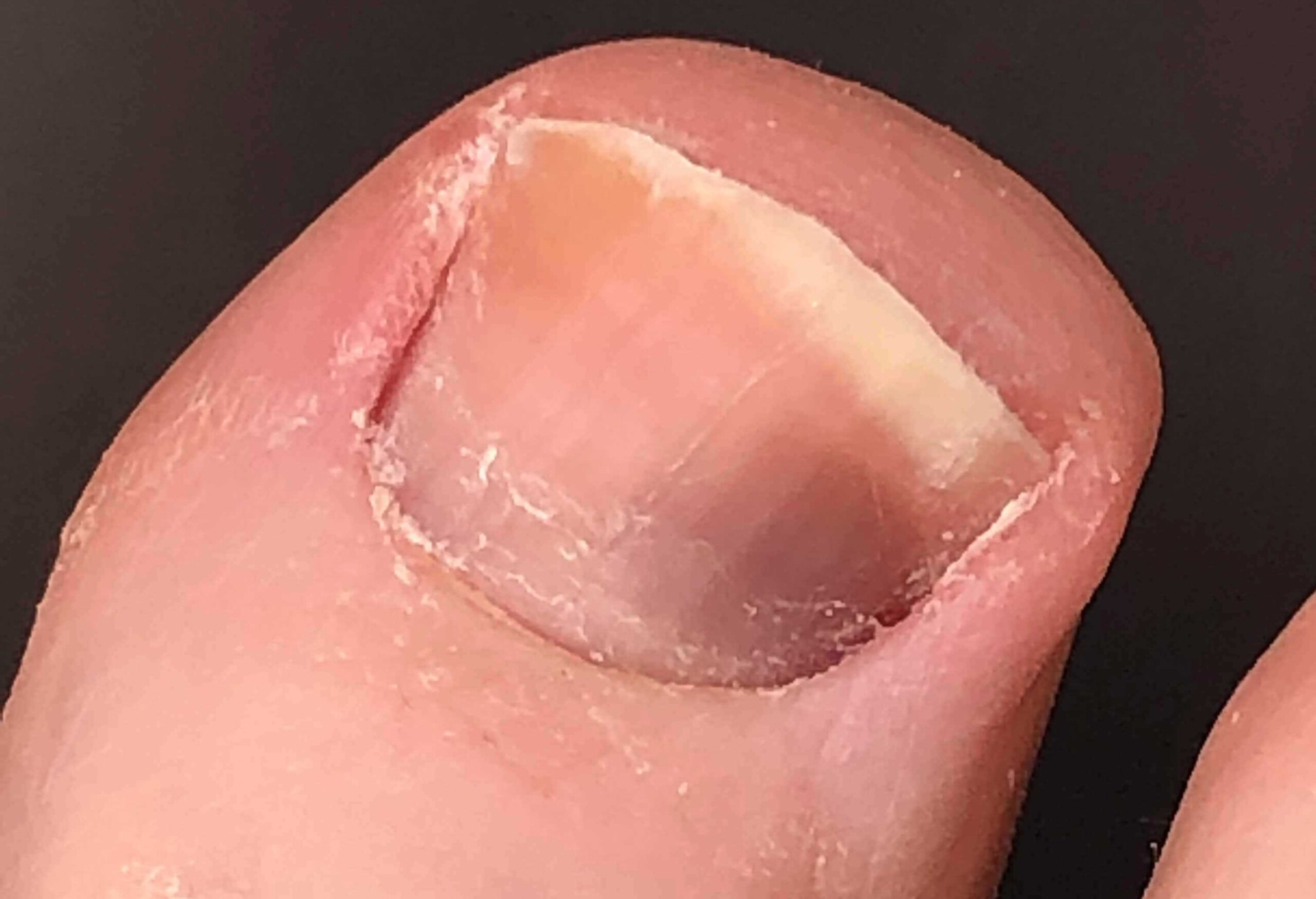 melanoma fingernail pictures