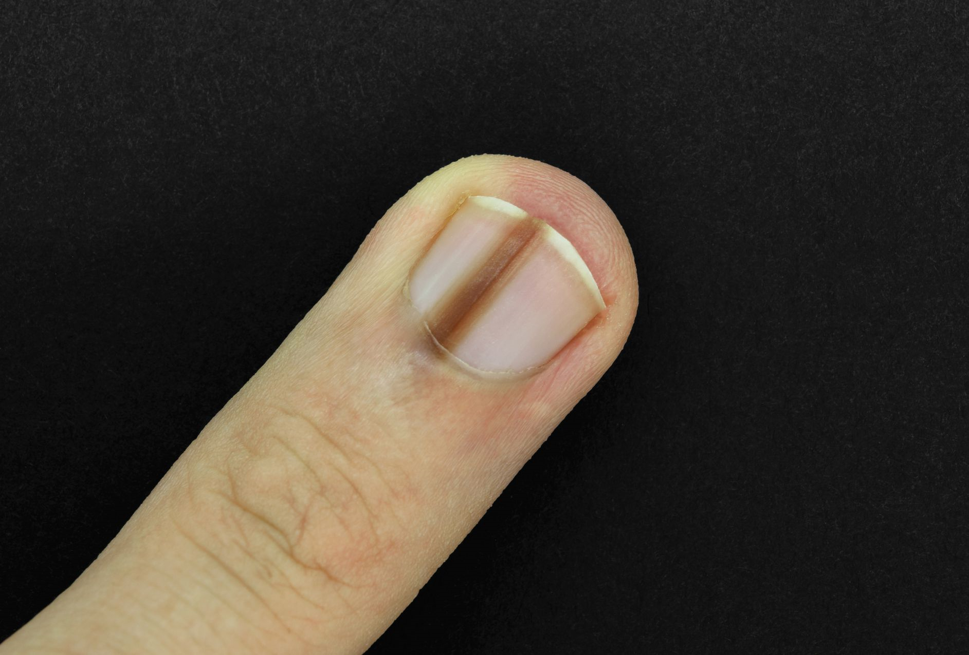 melanoma images on fingernails