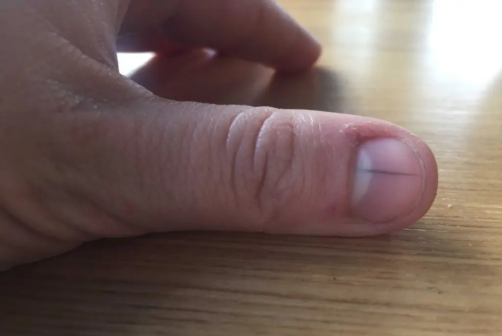 melanoma nail cancer pictures