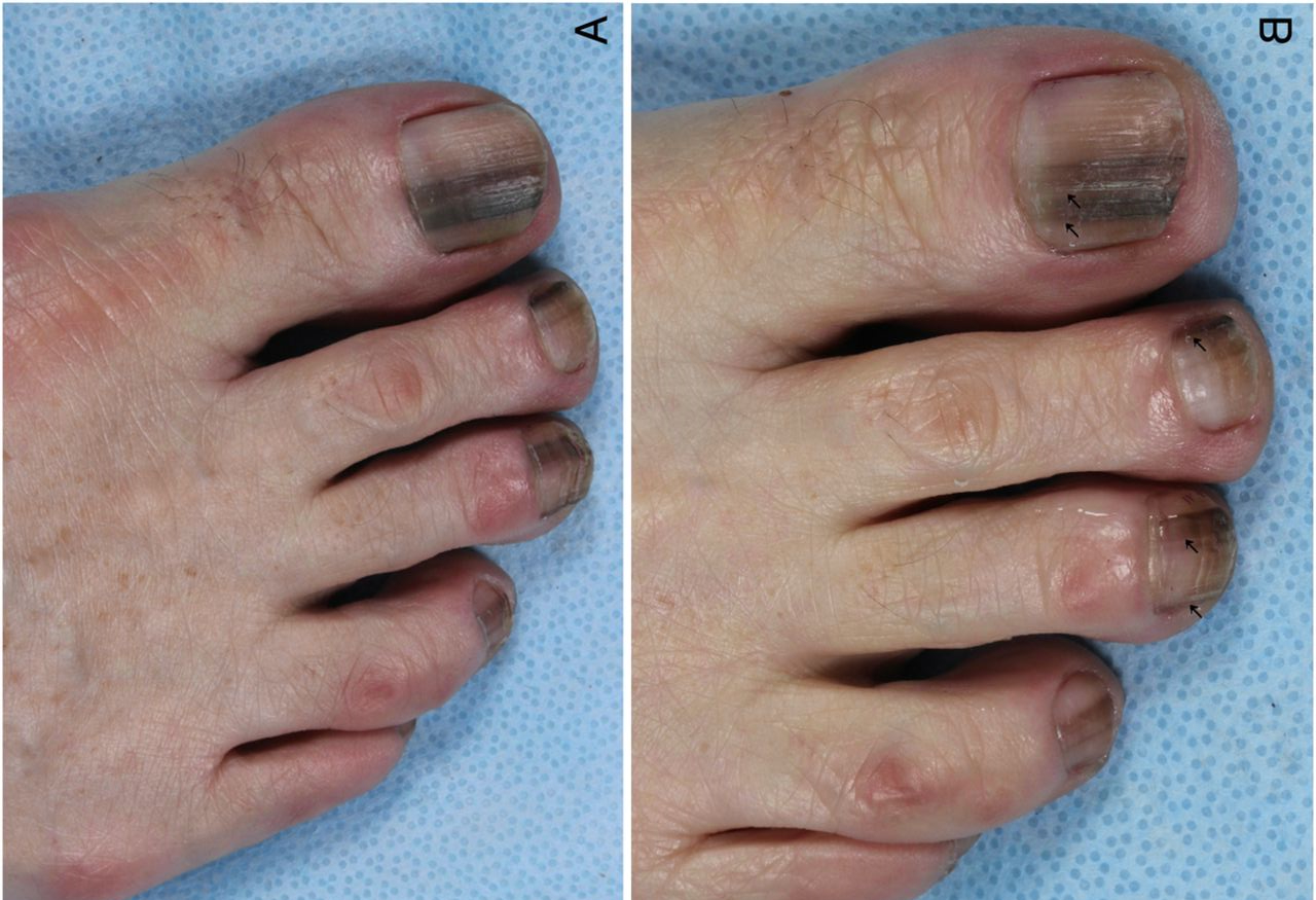 melanoma nail images