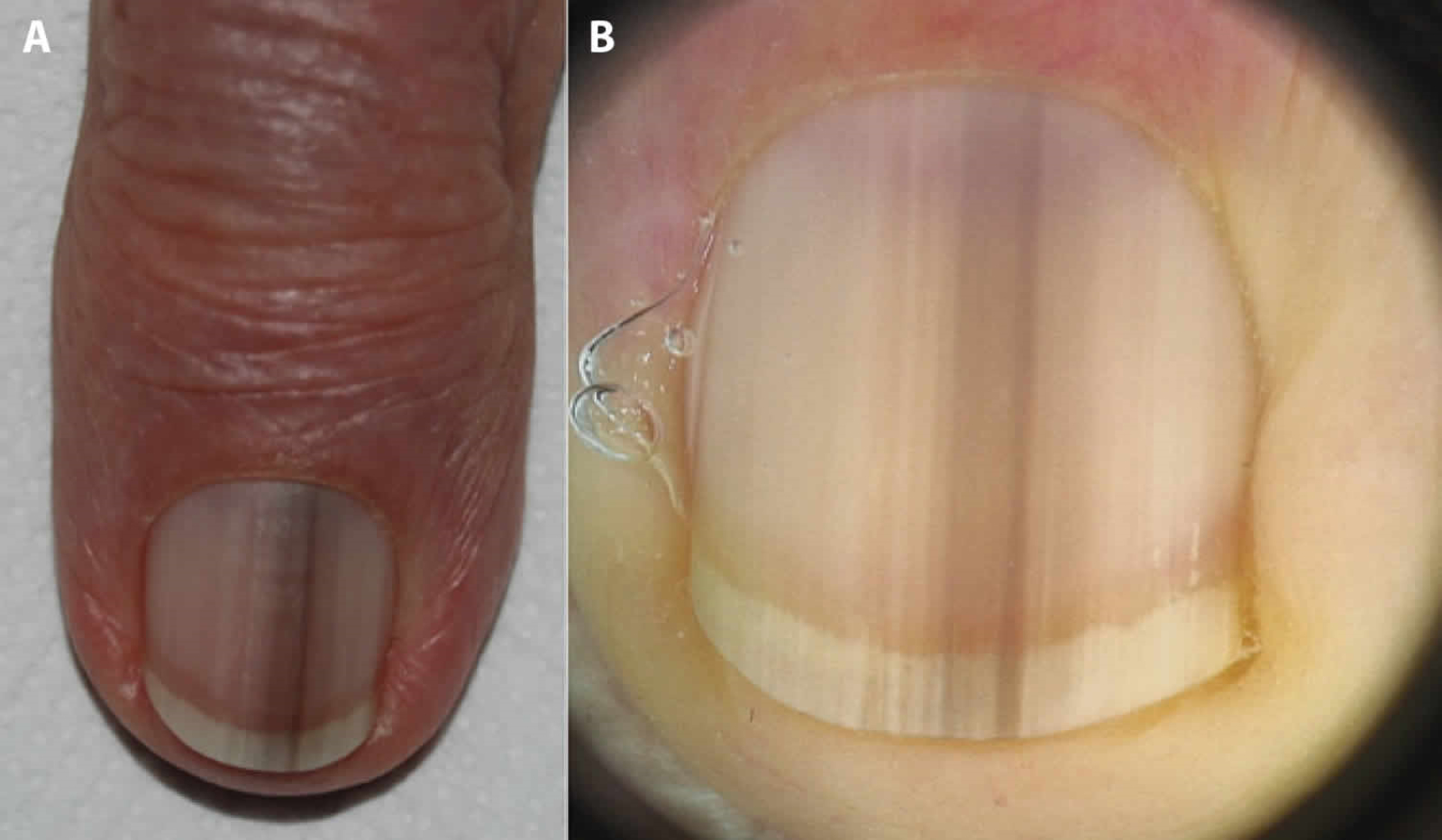 melanoma of nail bed image