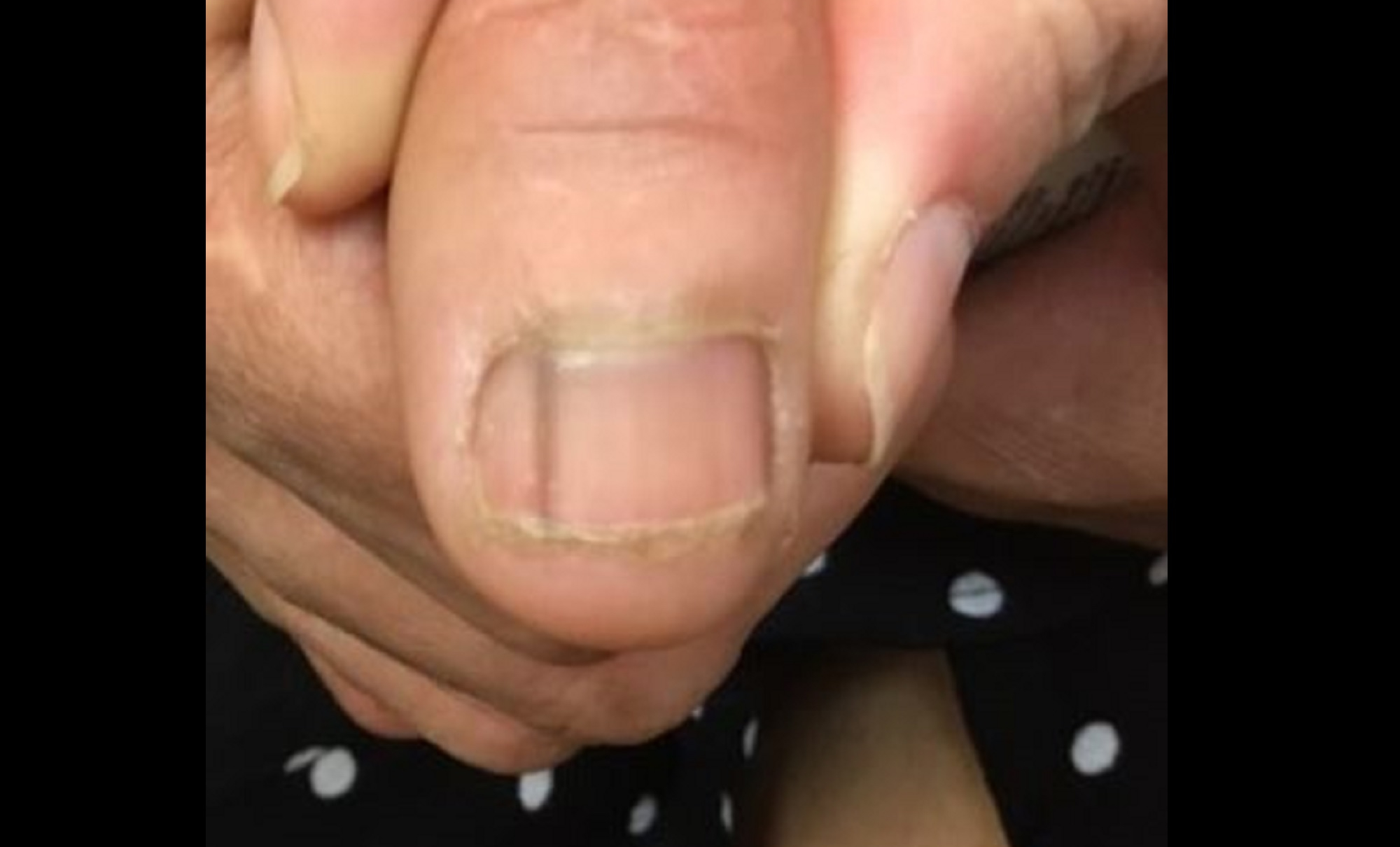 melanoma on toenail photos