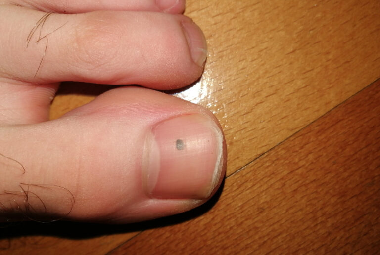 melanoma-toenail-image-symptoms-and-pictures