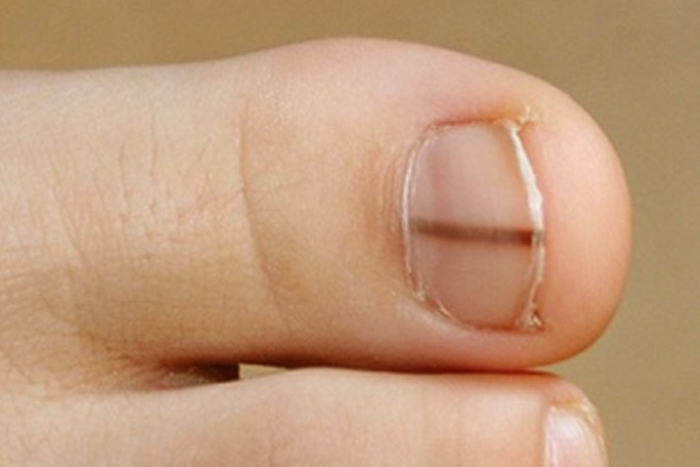 melanoma toenail pics