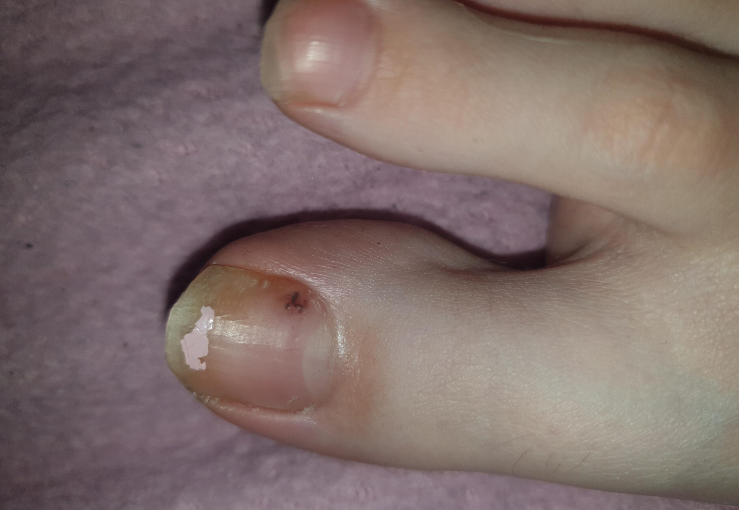 melanoma toenail picture