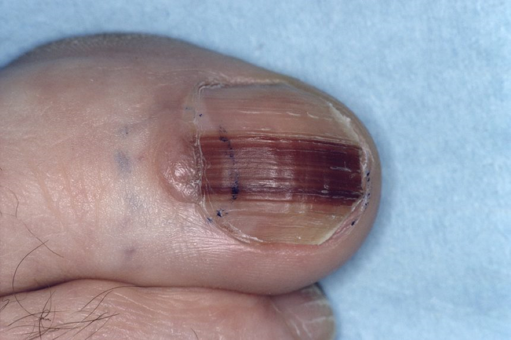 melanoma under big toenail images