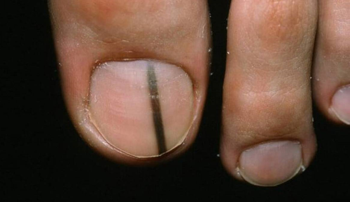 melanoma under nail pictures