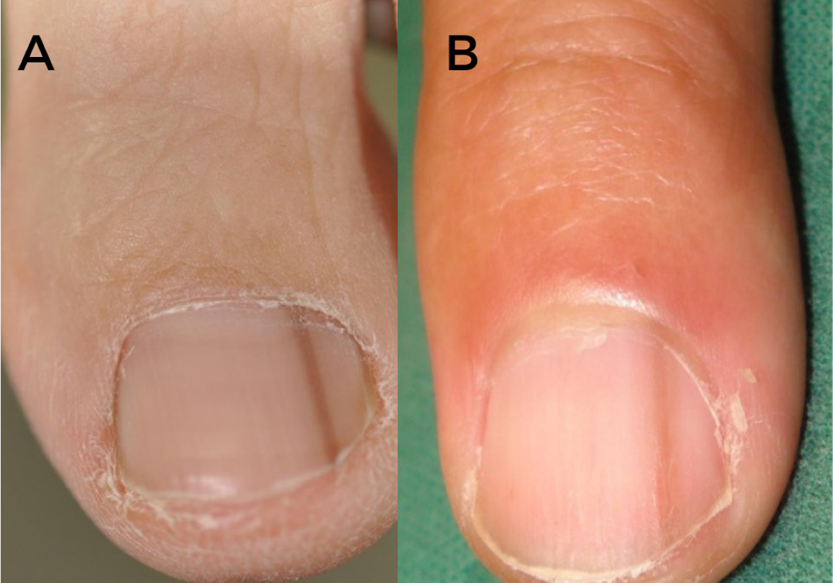 melanoma under toenail images