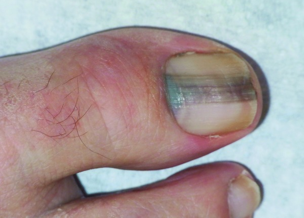 melanoma under toenail images