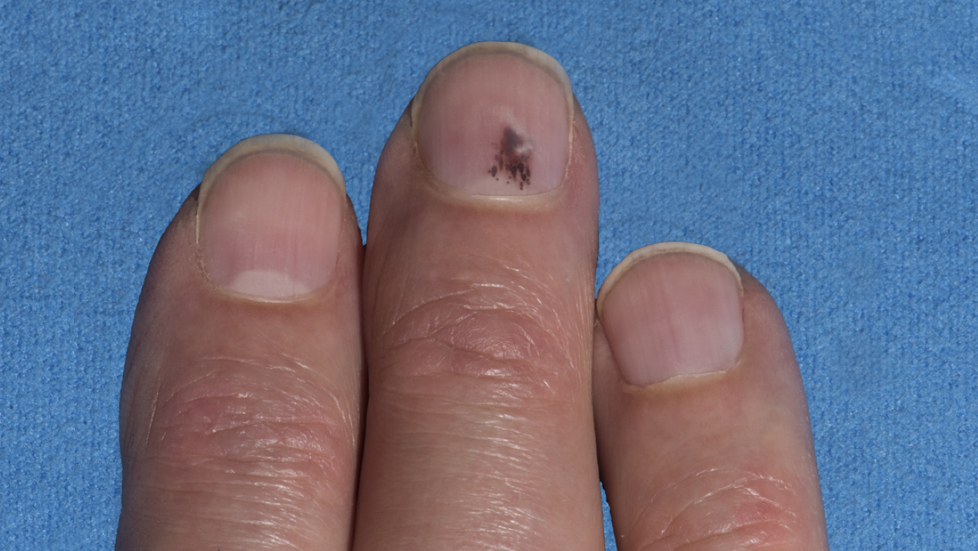 mole under nail pictures