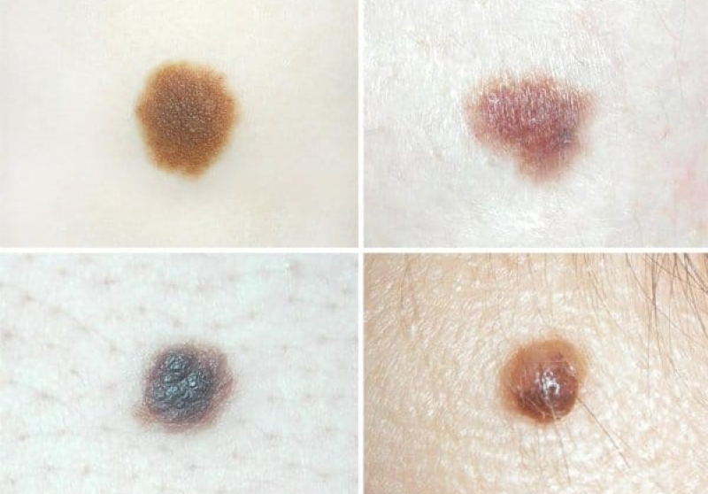 Moles That Are Cancerous Images Symptoms And Pictures