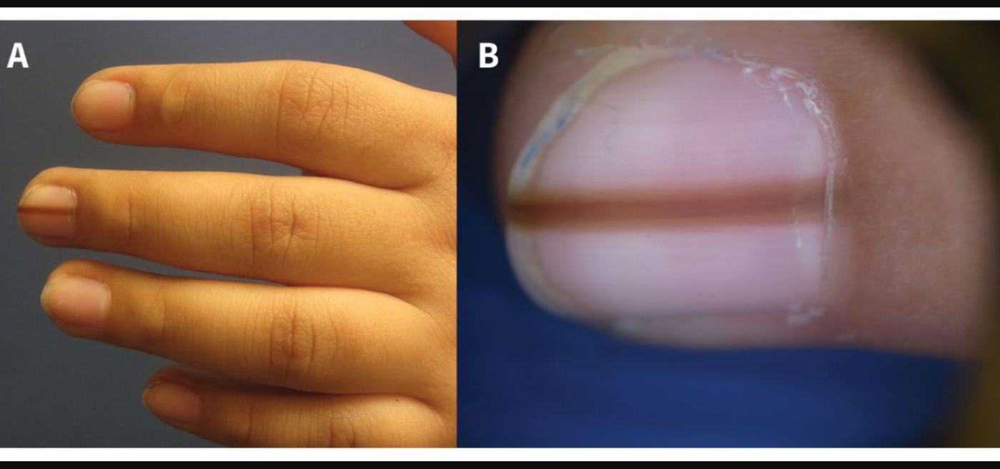 nail melanoma images