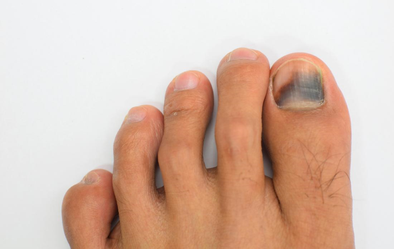 nail melanoma picture