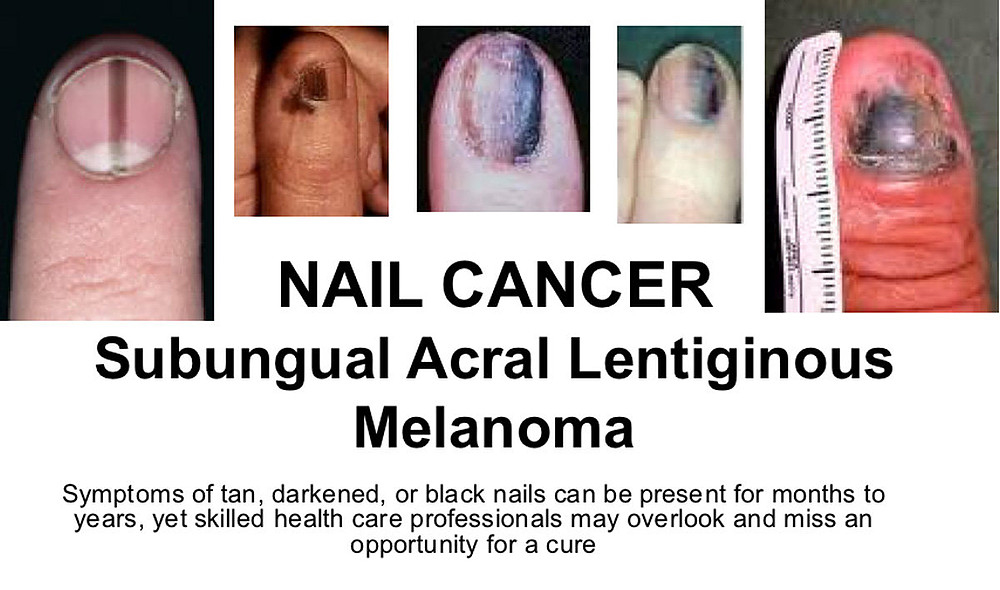 nail melanoma pictures