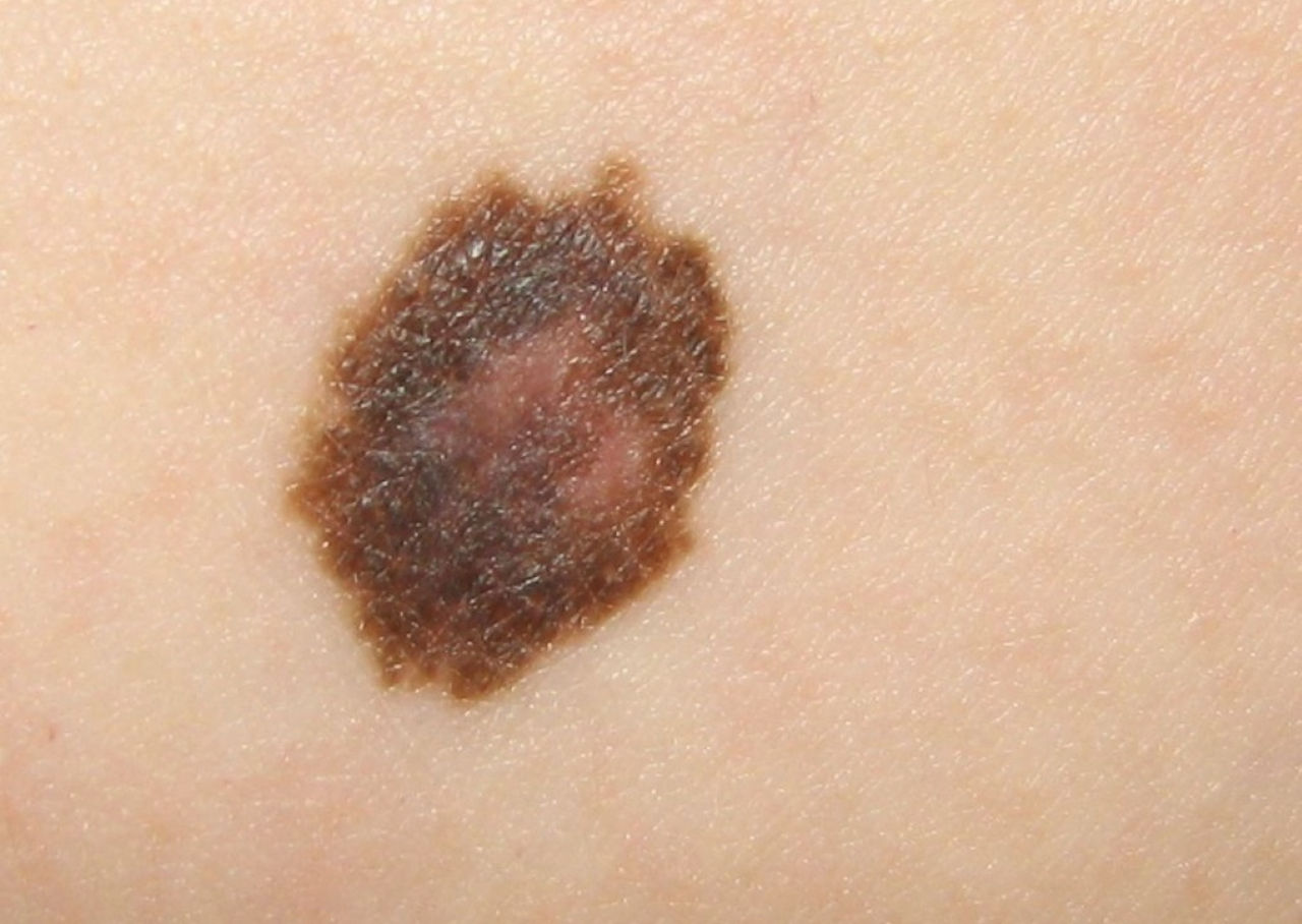 photos of cancerous moles