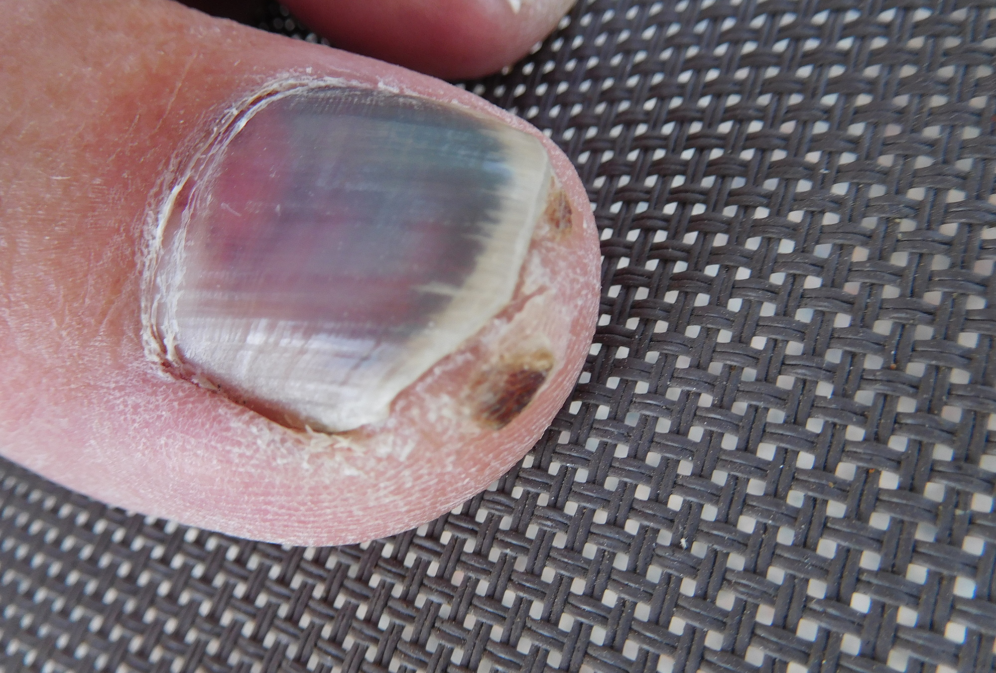 photos of melanoma under toenail