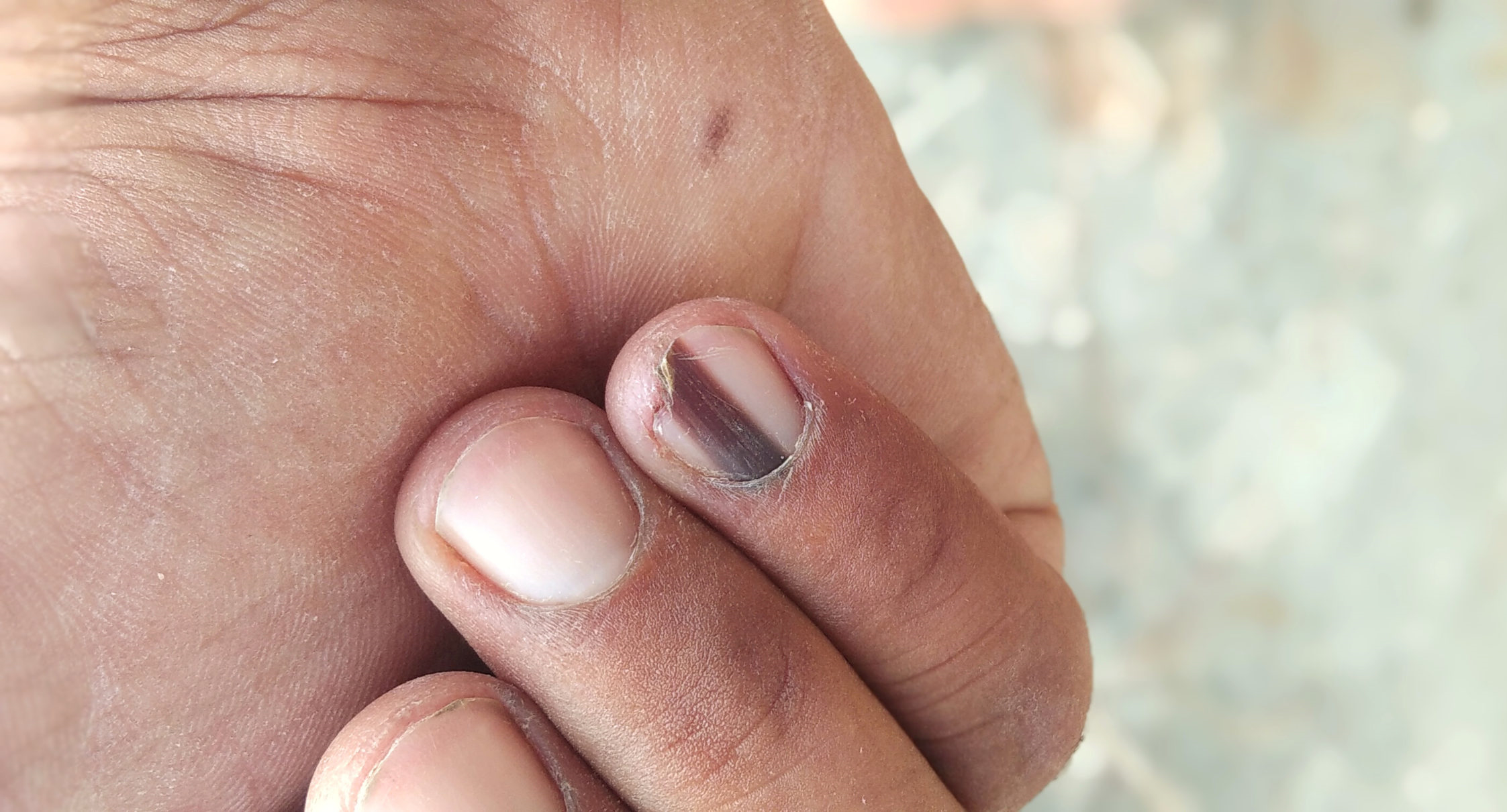 photos of toenail melanoma