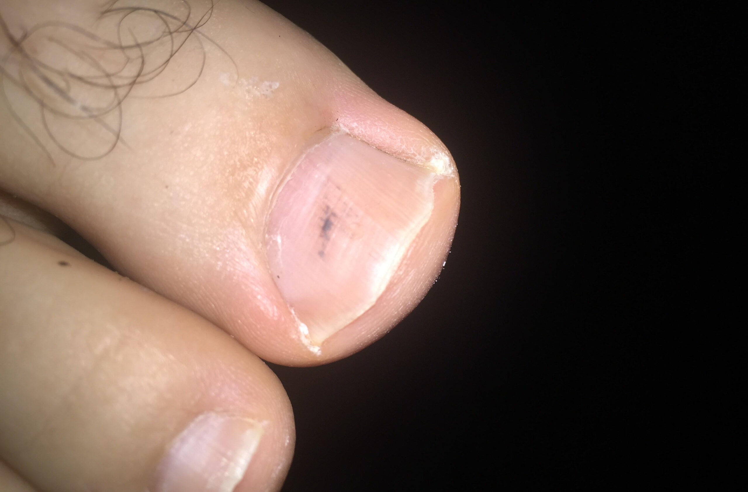 picture of melanoma under toenail