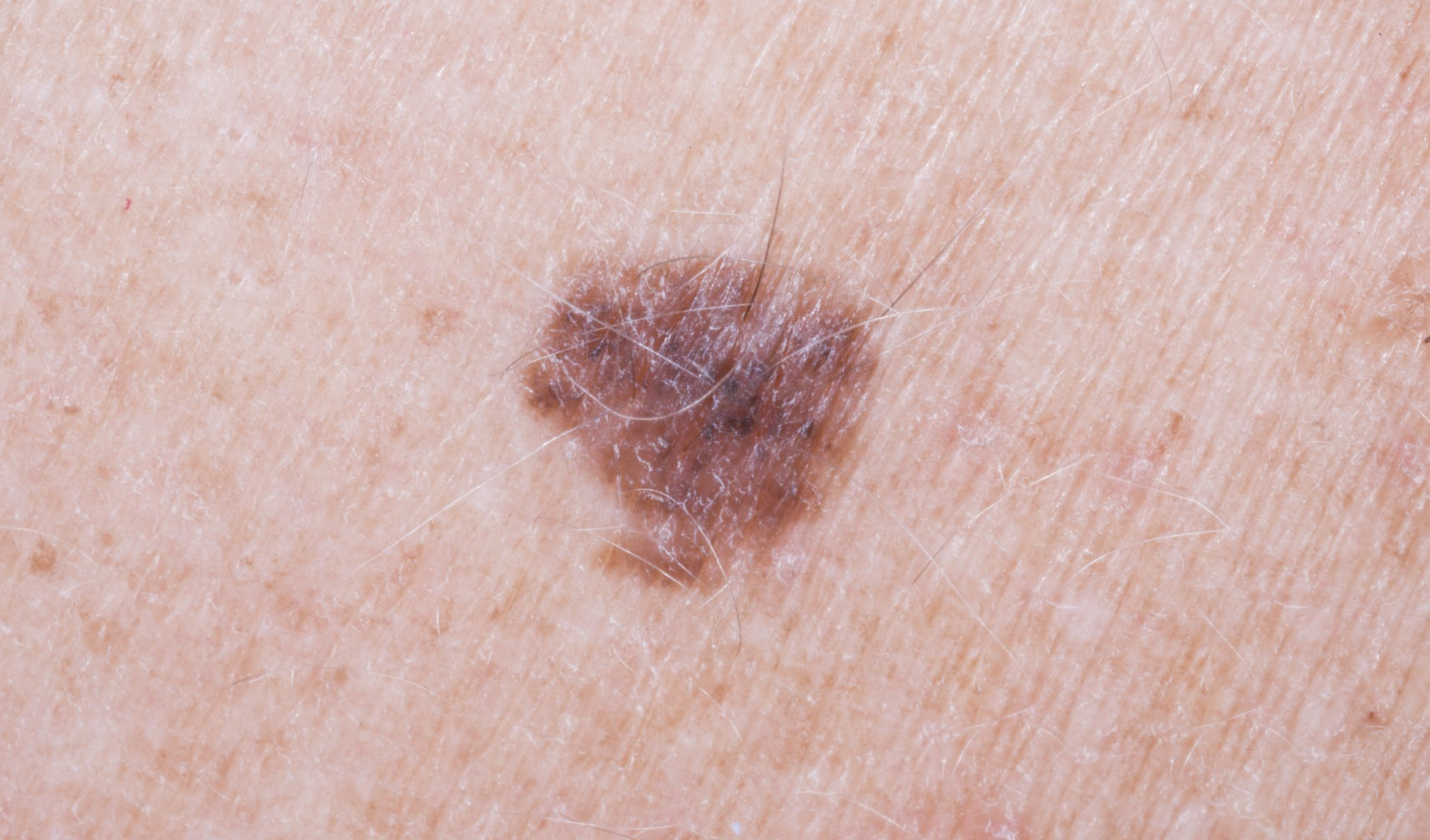 pictures of cancerous moles nhs