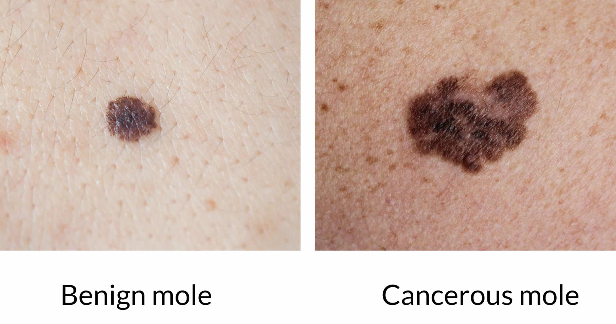Pictures Of Cancerous Moles 