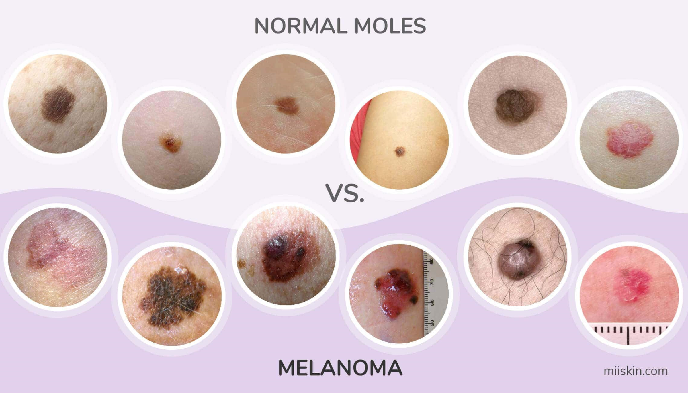 pictures of non cancerous moles
